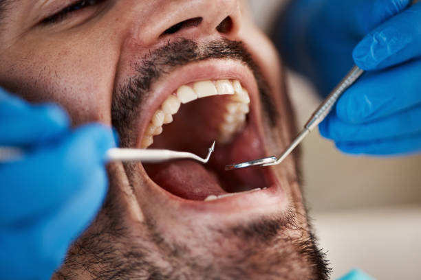 Best Emergency Wisdom Teeth Removal in Warren, OH